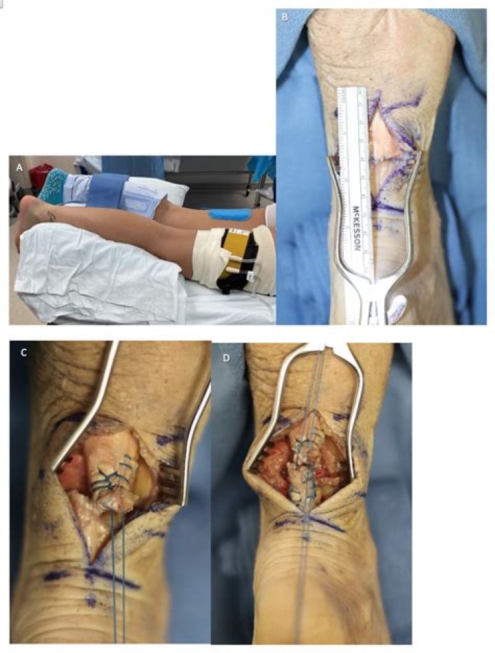 How Much Does It Cost To Repair An Achilles Tendon
