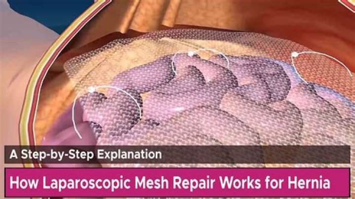 Quick Answer: How To Repair Mesh In Tent