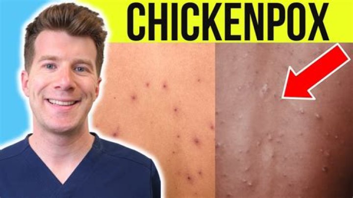 Quick Answer: Will Dogs Get Chicken Pox
